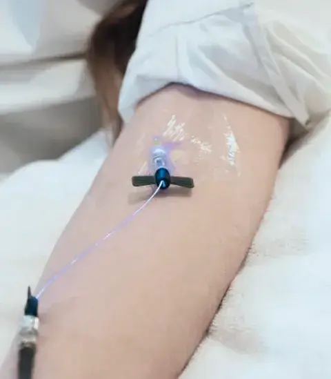 手臂靜脈留置針照射血液