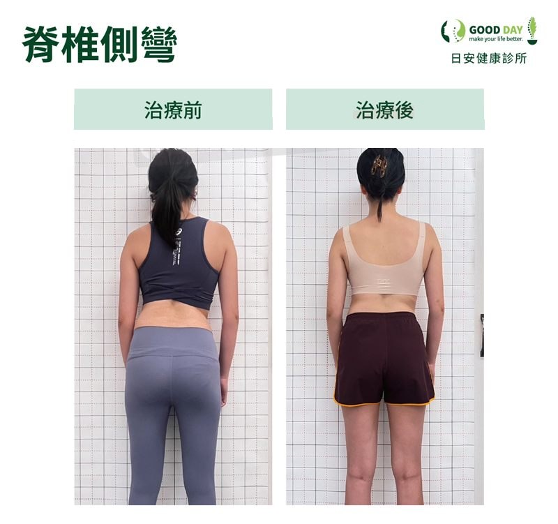 脊椎側彎(女性)療程前後的背部姿勢比較