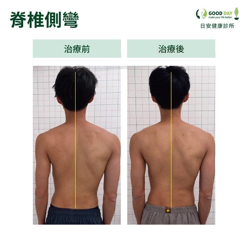 脊椎側彎(男性)療程前後的背部姿勢比較