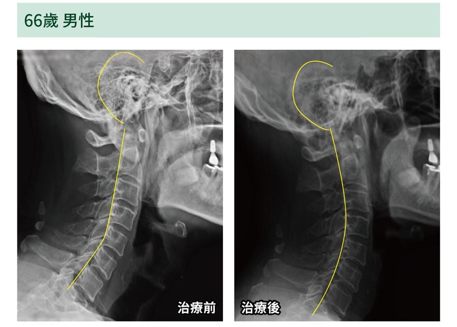 頸椎側面 X 光,療程前後比較:頸椎弧度變化